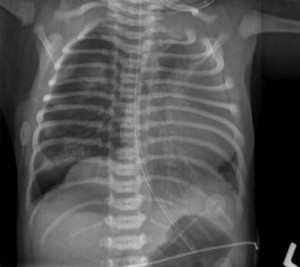 Kubtec_Pneumothorax 400