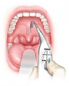 PillarProcedure